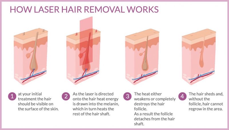 laser hair removal2