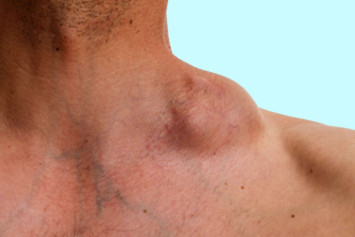 lymphoma 2