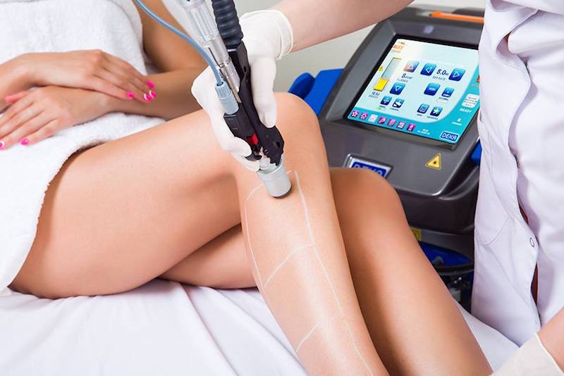 laser hair removal3